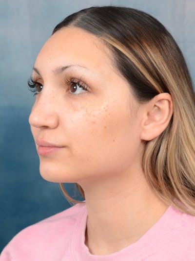 Rhinoplasty Before & After Gallery - Patient 101369578 - Image 4