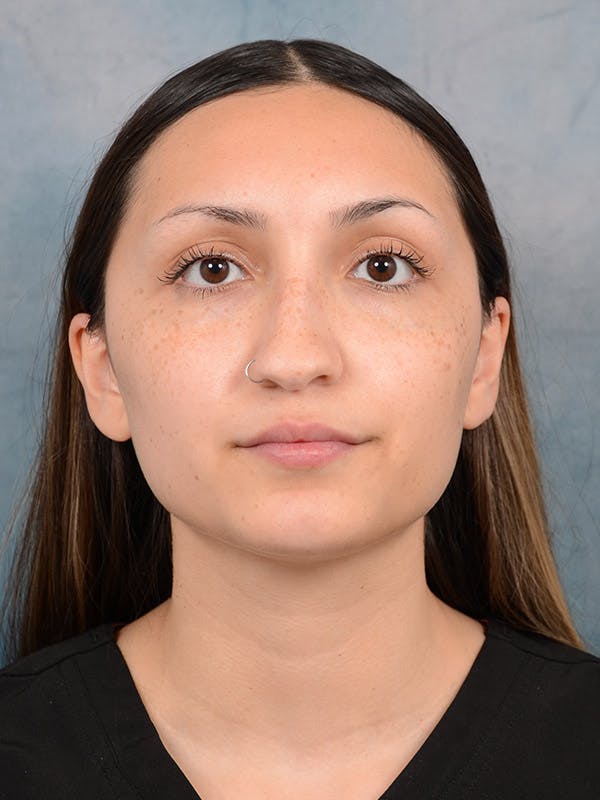 Rhinoplasty Before & After Gallery - Patient 101369578 - Image 5