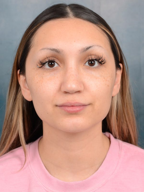 Rhinoplasty Before & After Gallery - Patient 101369578 - Image 6