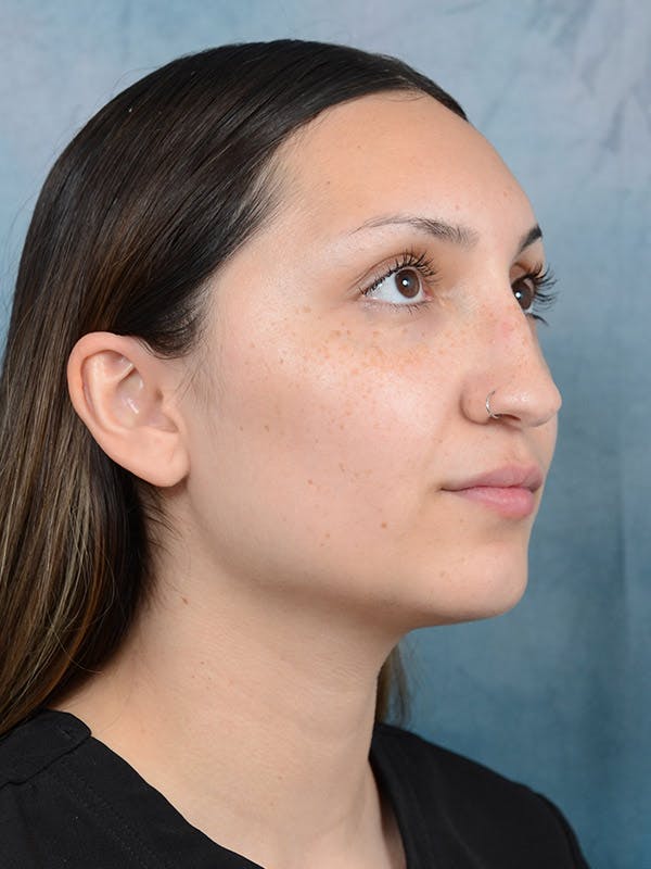 Rhinoplasty Before & After Gallery - Patient 101369578 - Image 7