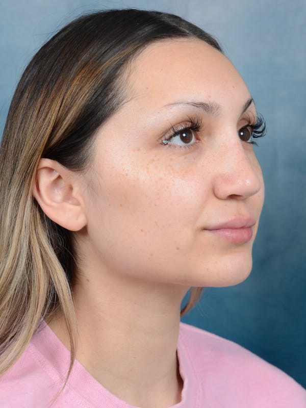 Rhinoplasty Before & After Gallery - Patient 101369578 - Image 8
