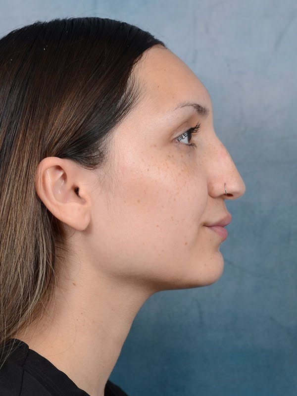 Rhinoplasty Before & After Gallery - Patient 101369578 - Image 9