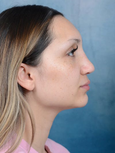 Rhinoplasty Before & After Gallery - Patient 101369578 - Image 10
