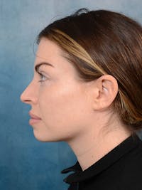 Rhinoplasty Before & After Gallery - Patient 101723709 - Image 1