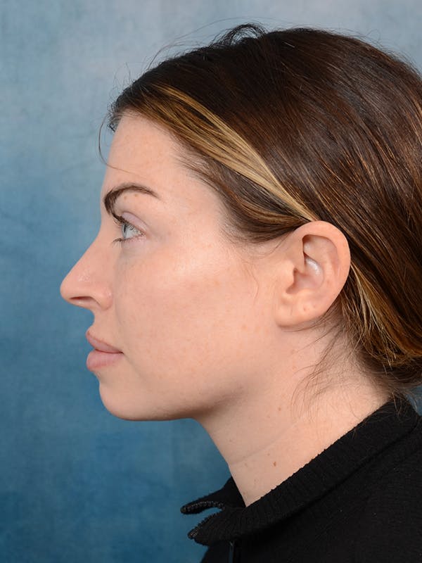 Rhinoplasty Before & After Gallery - Patient 101723709 - Image 1