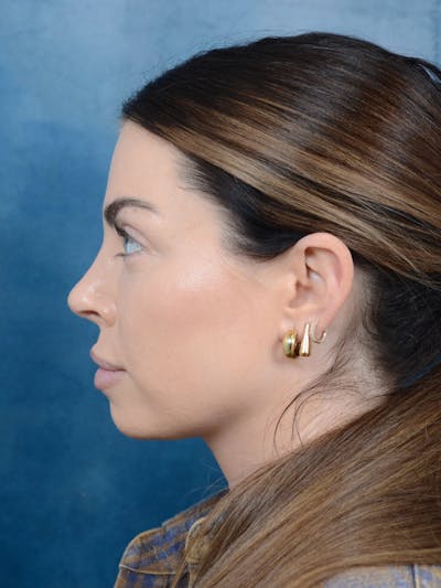 Rhinoplasty Before & After Gallery - Patient 101723709 - Image 2