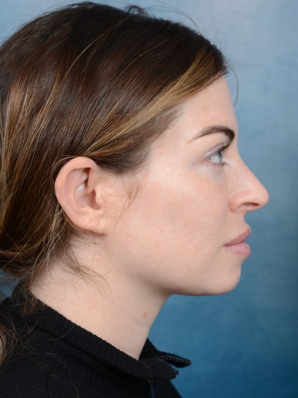 Rhinoplasty Before & After Gallery - Patient 101723709 - Image 9