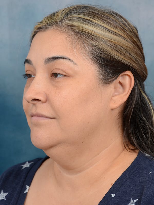 Deep Plane Facelift Before & After Gallery - Patient 101723729 - Image 1