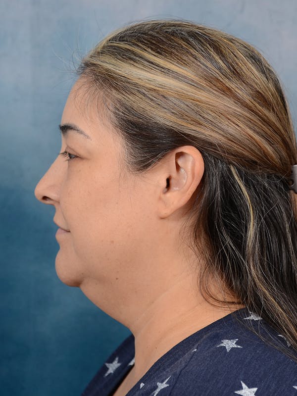 Deep Plane Facelift Before & After Gallery - Patient 101723729 - Image 3