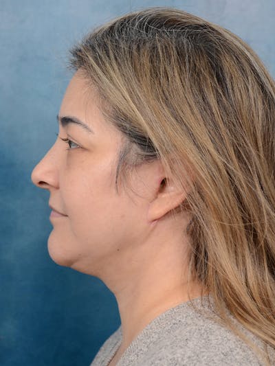 Deep Plane Facelift Before & After Gallery - Patient 101723729 - Image 4