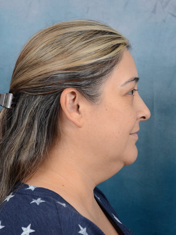Deep Plane Facelift Before & After Gallery - Patient 101723729 - Image 7