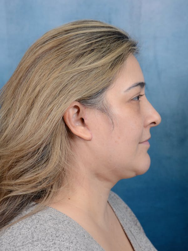 Deep Plane Facelift Before & After Gallery - Patient 101723729 - Image 8