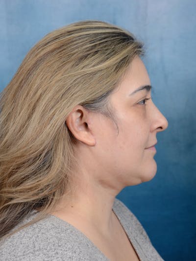 Deep Plane Facelift Before & After Gallery - Patient 101723729 - Image 8