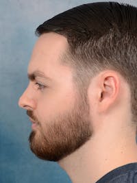 Rhinoplasty Before & After Gallery - Patient 106313577 - Image 1