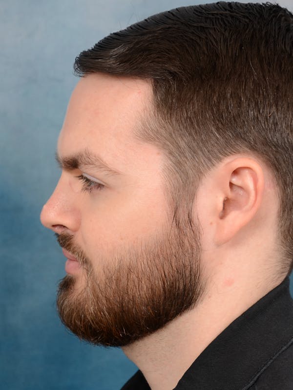 Rhinoplasty Before & After Gallery - Patient 106313577 - Image 2
