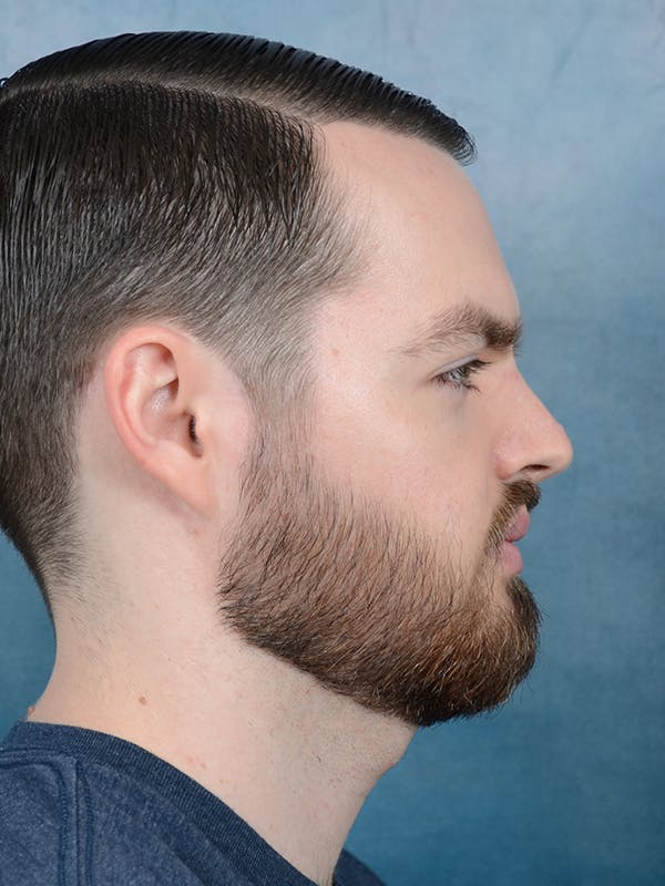 Rhinoplasty Before & After Gallery - Patient 106313577 - Image 9