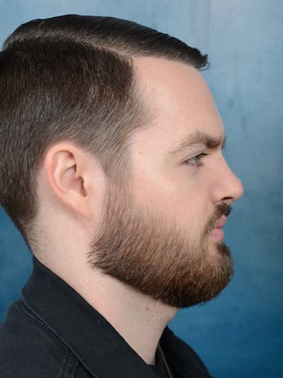Rhinoplasty Before & After Gallery - Patient 106313577 - Image 10