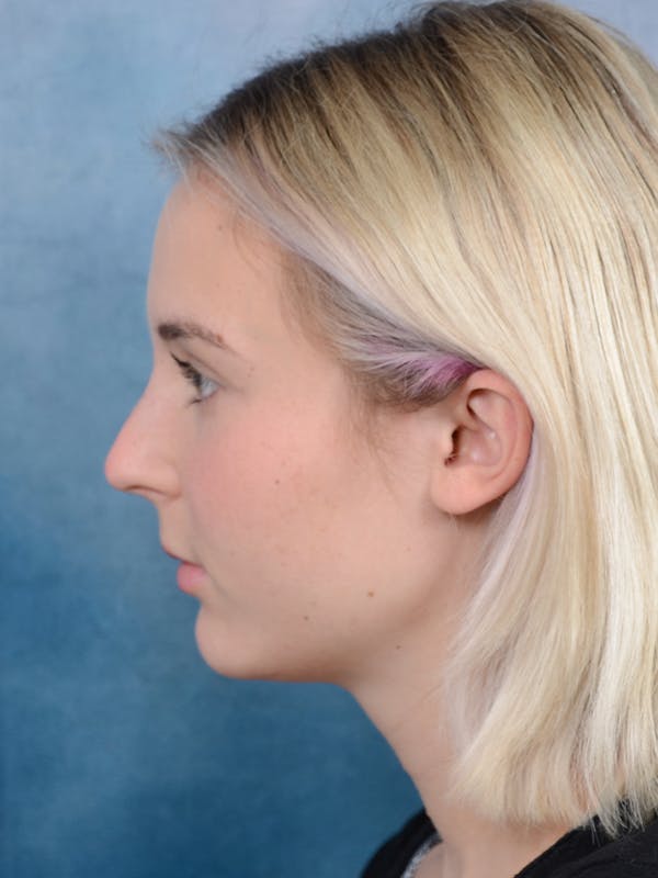 Rhinoplasty Before & After Gallery - Patient 106313578 - Image 1