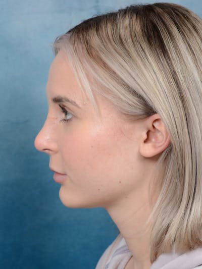 Rhinoplasty Before & After Gallery - Patient 106313578 - Image 2