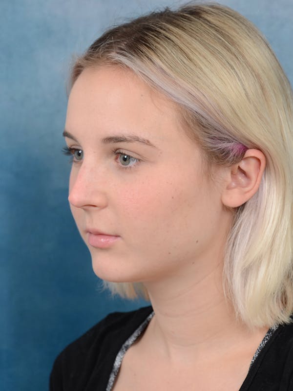 Rhinoplasty Before & After Gallery - Patient 106313578 - Image 5