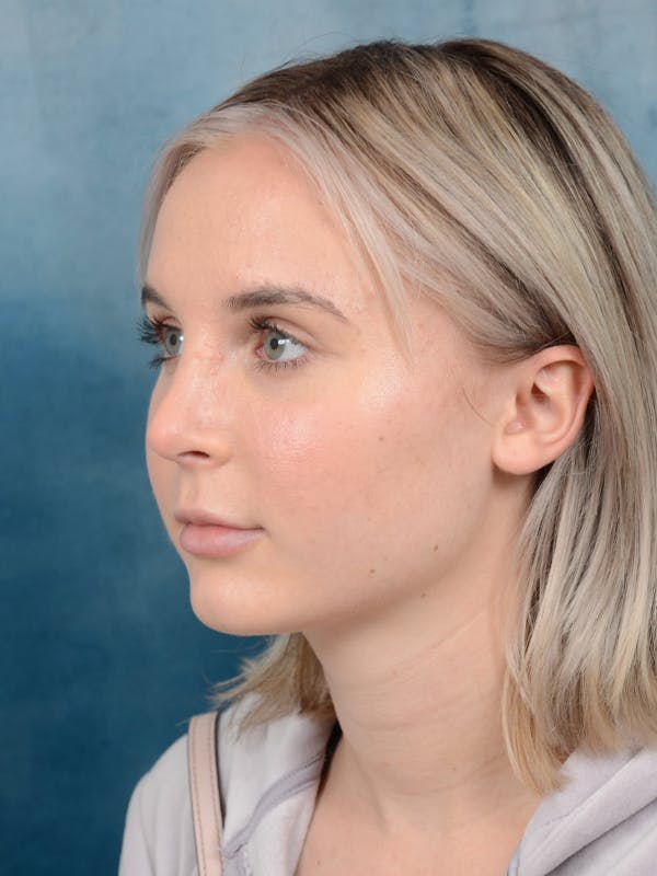 Rhinoplasty Before & After Gallery - Patient 106313578 - Image 6