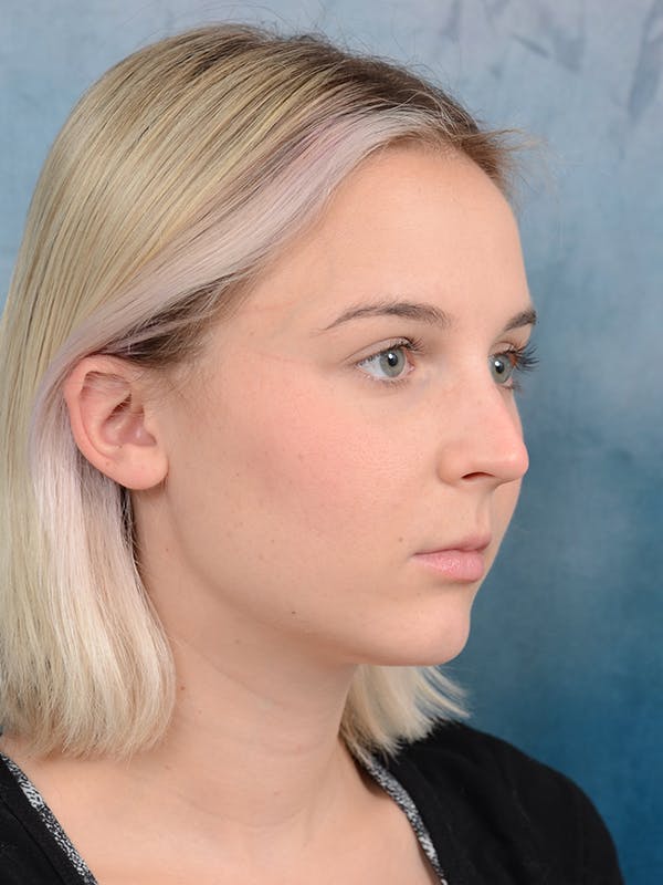Rhinoplasty Before & After Gallery - Patient 106313578 - Image 7
