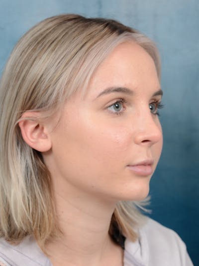 Rhinoplasty Before & After Gallery - Patient 106313578 - Image 8