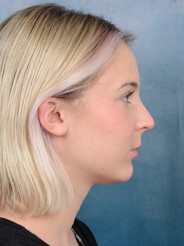 Rhinoplasty Before & After Gallery - Patient 106313578 - Image 9