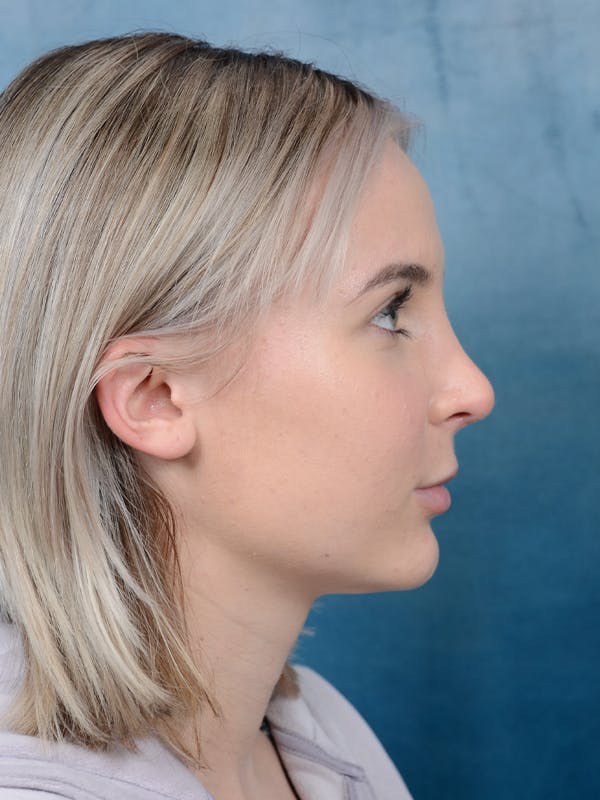 Rhinoplasty Before & After Gallery - Patient 106313578 - Image 10