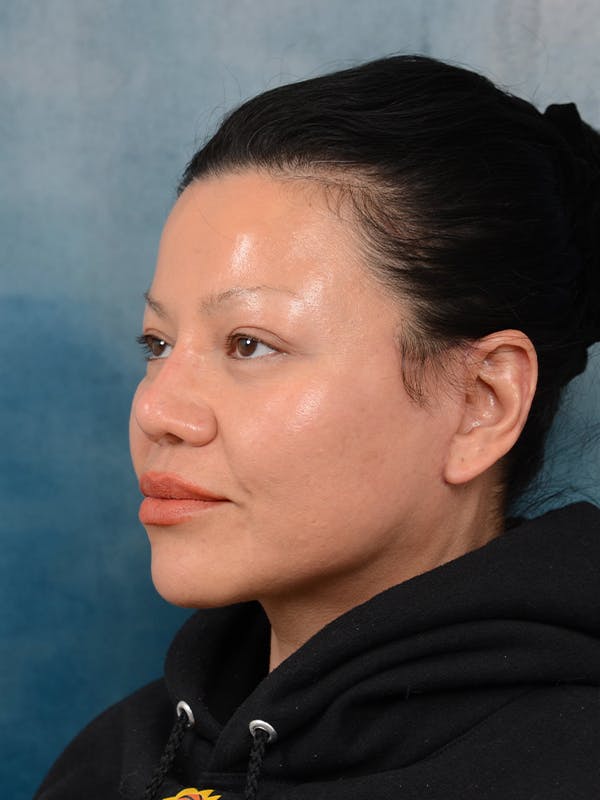Deep Plane Facelift Before & After Gallery - Patient 106313924 - Image 2