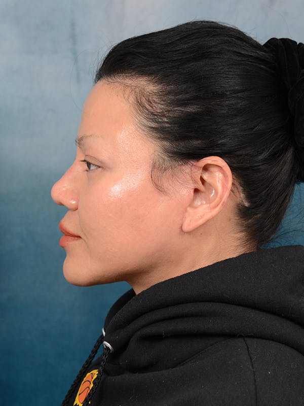 Brow Lift Before & After Gallery - Patient 106313929 - Image 6