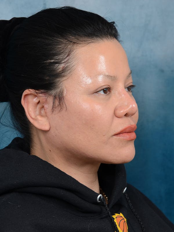 Deep Plane Facelift Before & After Gallery - Patient 106313924 - Image 8