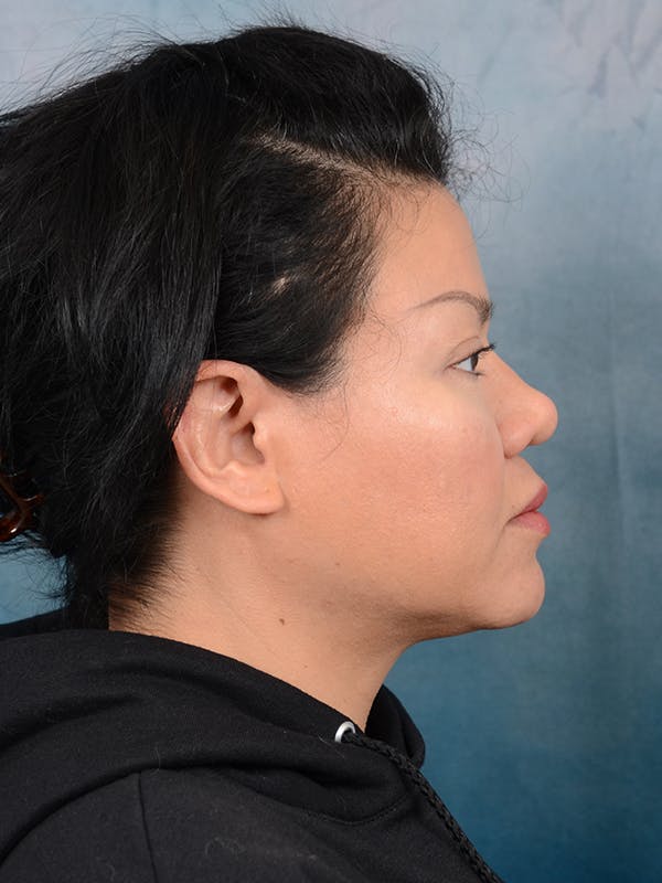 Deep Plane Facelift Before & After Gallery - Patient 106313924 - Image 9