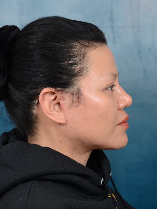 Deep Plane Facelift Before & After Gallery - Patient 106313924 - Image 10