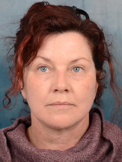 Deep Plane Facelift Before & After Gallery - Patient 111132906 - Image 4