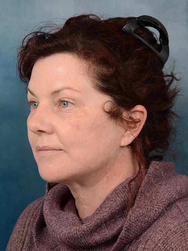 Laser Skin Resurfacing Before & After Gallery - Patient 111132912 - Image 4