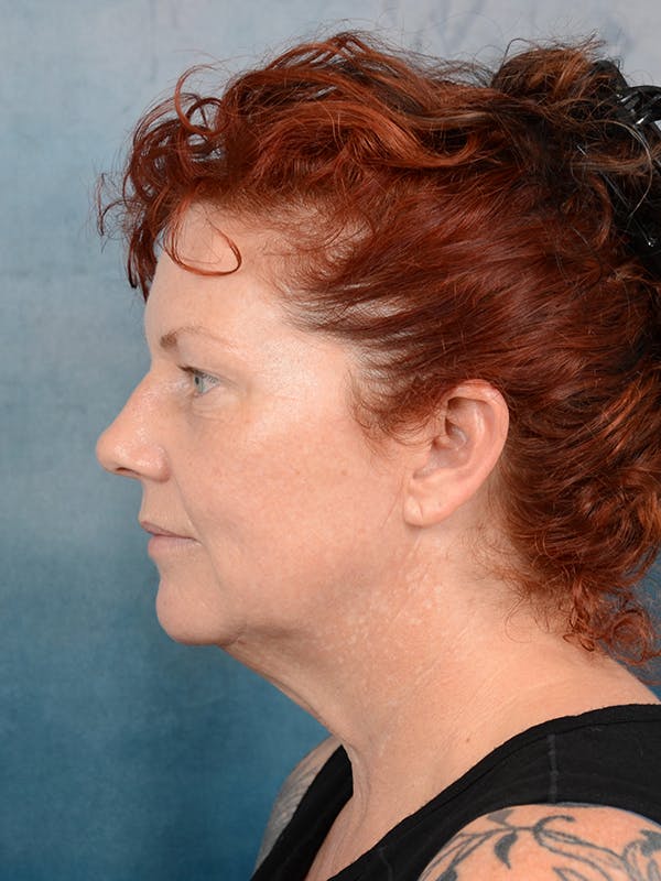 Deep Plane Facelift Before & After Gallery - Patient 111132906 - Image 5