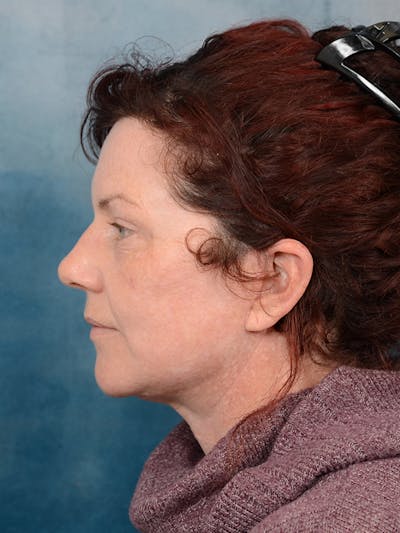 Deep Plane Facelift Before & After Gallery - Patient 111132906 - Image 6