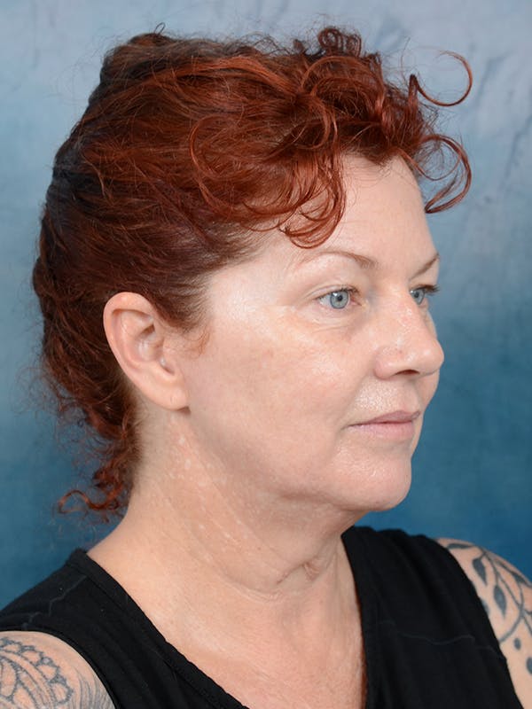 Deep Plane Facelift Before & After Gallery - Patient 111132906 - Image 7