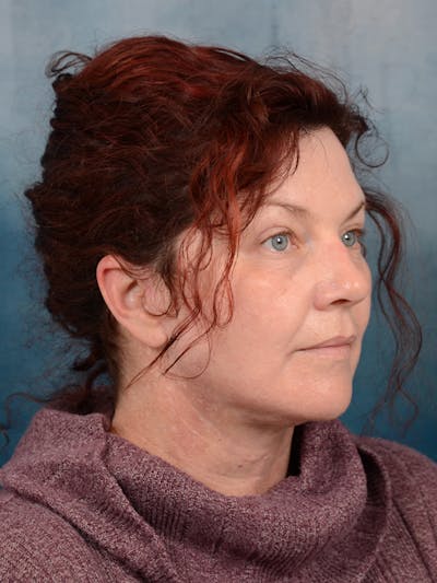 Deep Plane Facelift Before & After Gallery - Patient 111132906 - Image 8