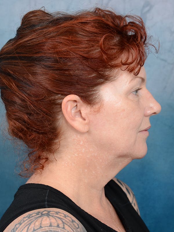 Deep Plane Facelift Before & After Gallery - Patient 111132906 - Image 9