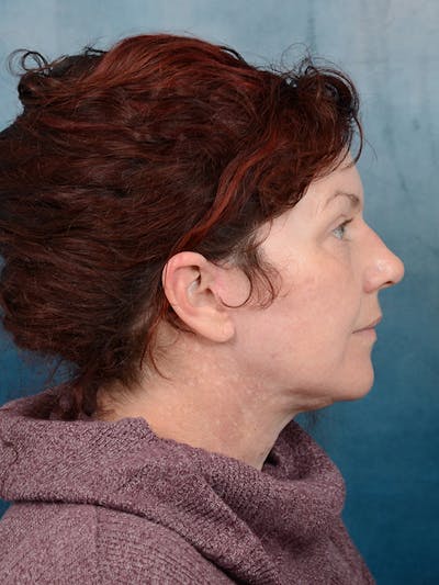 Deep Plane Facelift Before & After Gallery - Patient 111132906 - Image 10