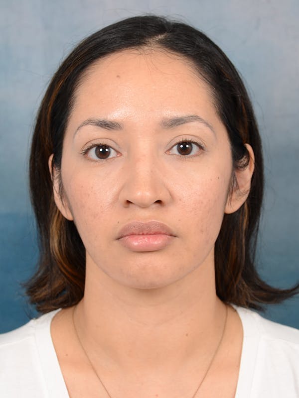 Rhinoplasty Before & After Gallery - Patient 111134284 - Image 3