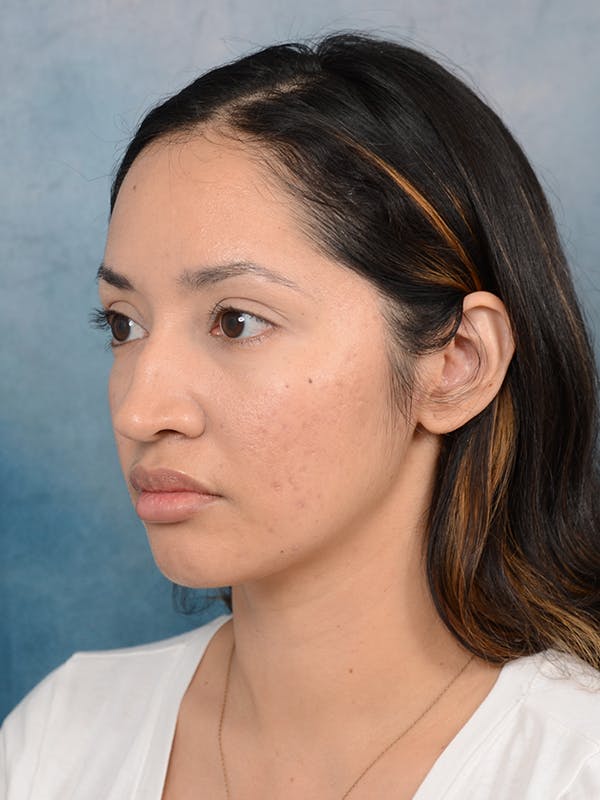 Rhinoplasty Before & After Gallery - Patient 111134284 - Image 5