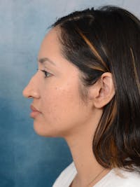 Rhinoplasty Before & After Gallery - Patient 111134284 - Image 1