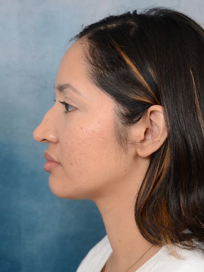 Rhinoplasty Before & After Gallery - Patient 111134284 - Image 1