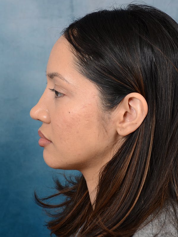 Rhinoplasty Before & After Gallery - Patient 111134284 - Image 2