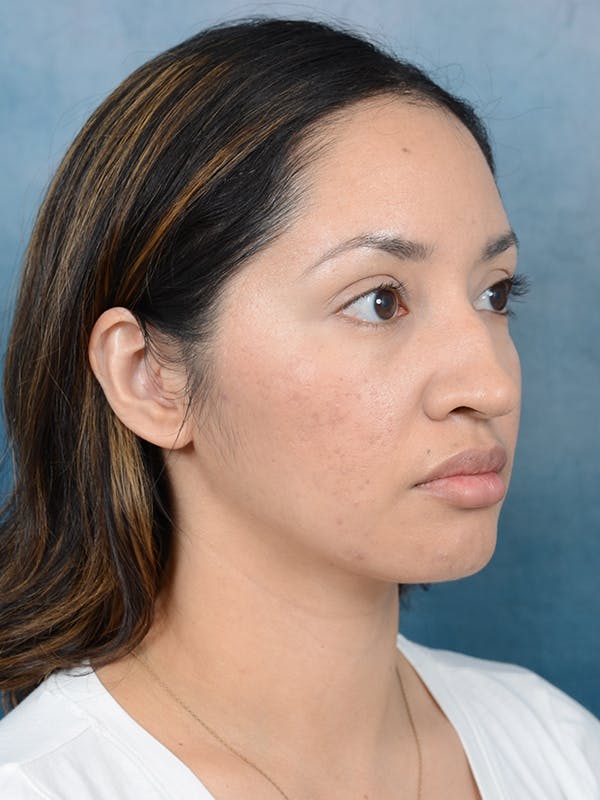 Rhinoplasty Before & After Gallery - Patient 111134284 - Image 7