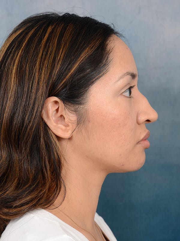 Rhinoplasty Before & After Gallery - Patient 111134284 - Image 9