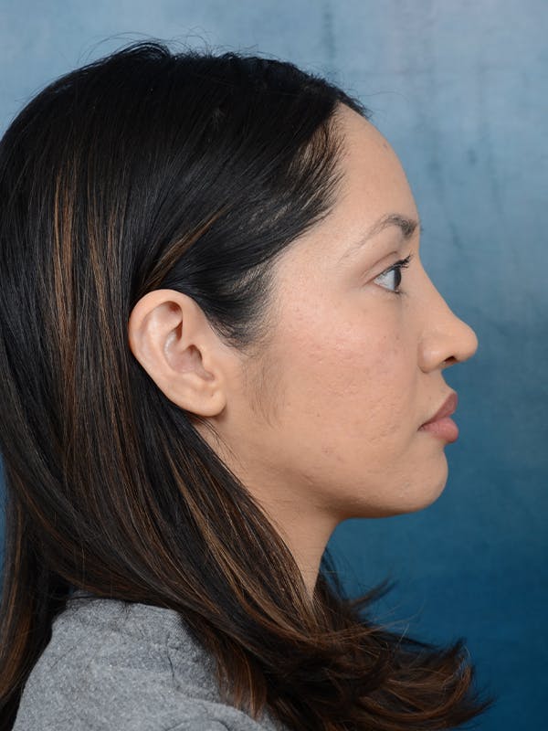 Rhinoplasty Before & After Gallery - Patient 111134284 - Image 10